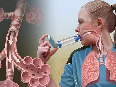 Атопическая бронхиальная астма — актуальная проблема современной медицины